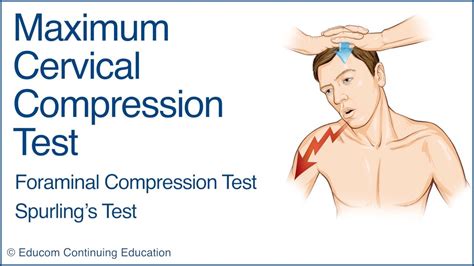 Spurling Test, Maximal Cervical Compression Test, 